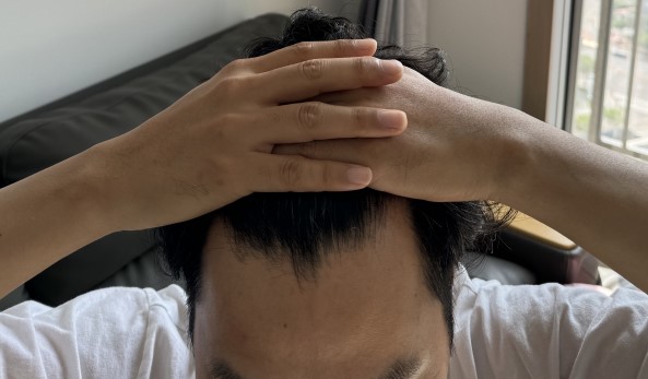 모원성형외과(정재홍원장님) 비절개 부분삭발 12일차 경과 후기