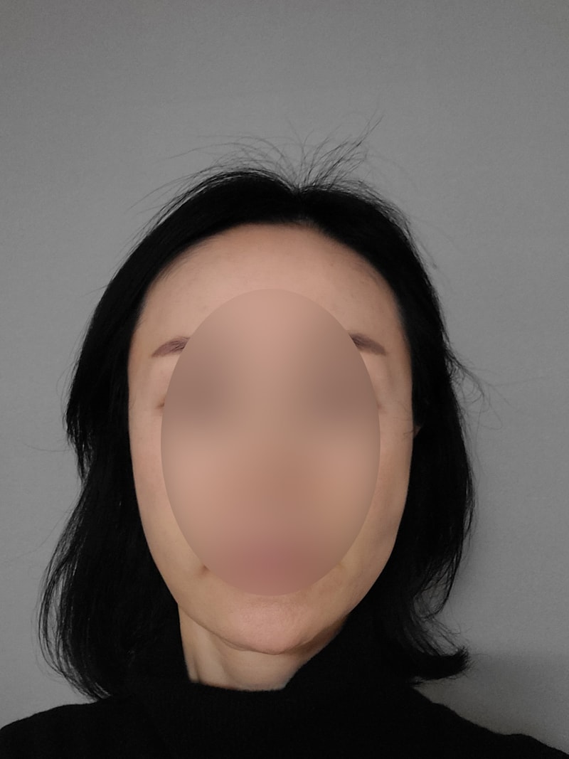 Park Jong-ok, Director of Mowon Plastic Surgery, on the 10th day of Women's Hairline 1,500 Hair Ornament