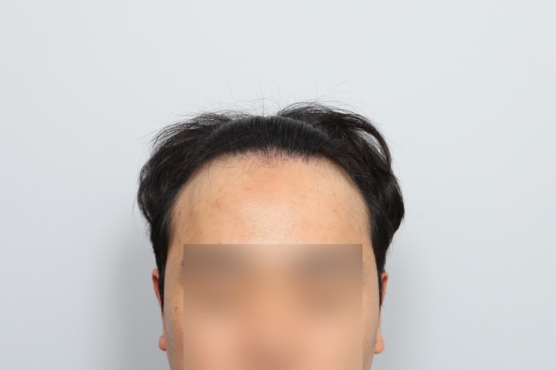 M자이마 헤어라인 비절개모발이식 1년 모원성형외과