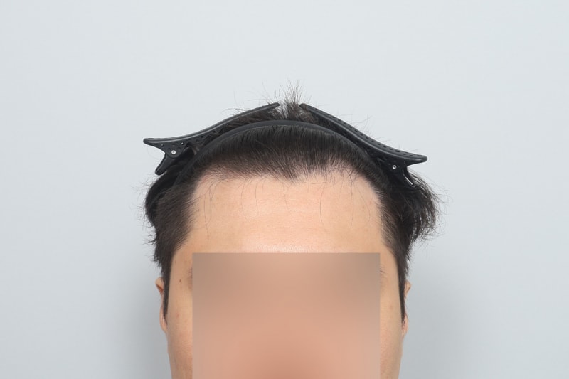 무삭발 비절개 모발이식 당일 후기 모원성형외과