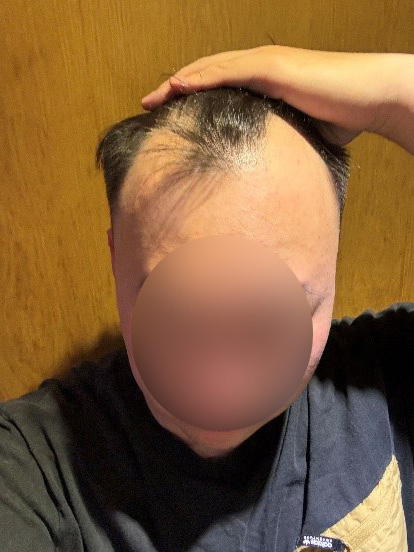 모원성형외과 비절개모발이식 4개월후기 정재홍원장님