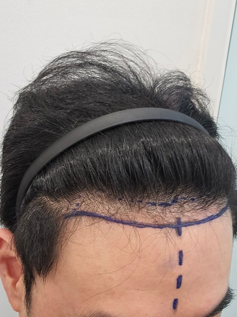모원성형외과 정재홍원장님께 모발이식 받고 후기 남겨봅니다