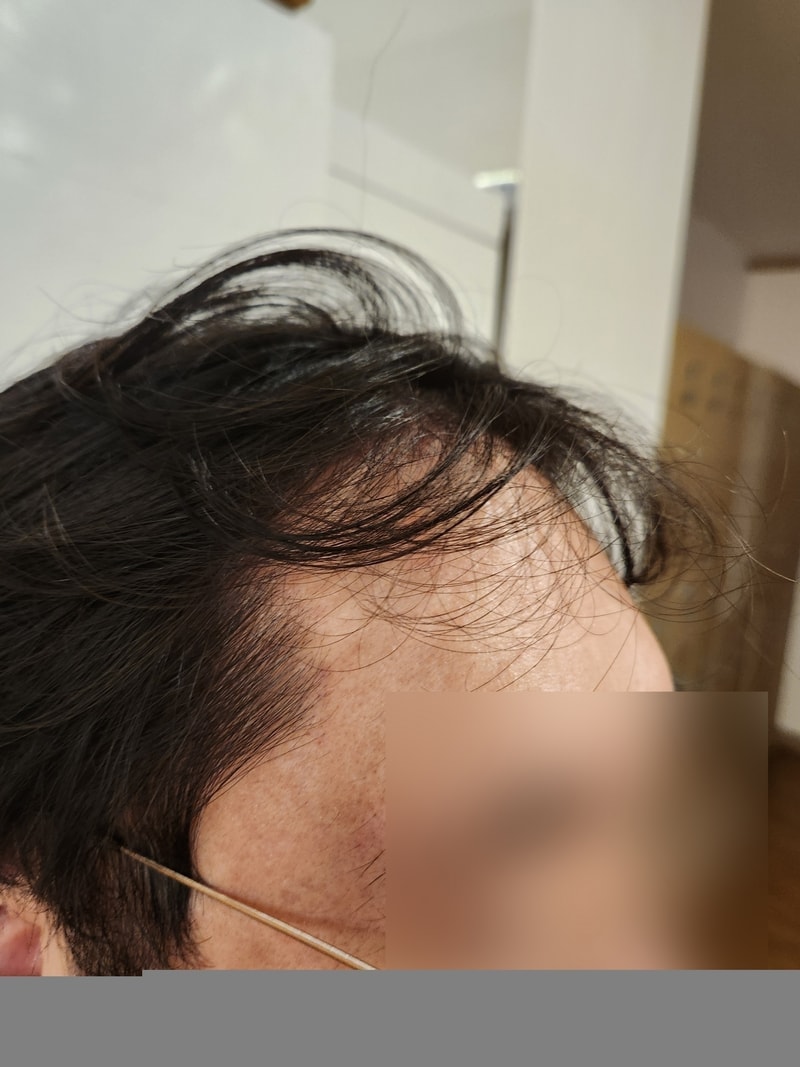 헤어라인이 생겼습니다 비절개모발이식 3개월 모원성형외과 정재홍원장님