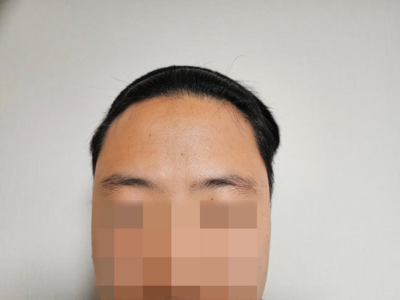 모원성형외과 M자 모발이식수술 1088모낭 7개월