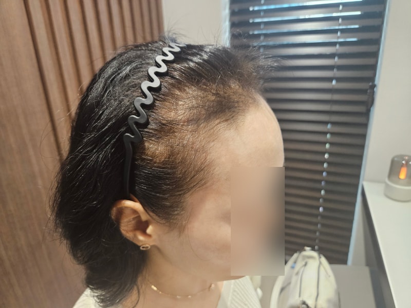 여자헤어라인 비절개모발이식 모원성형외과 4개월