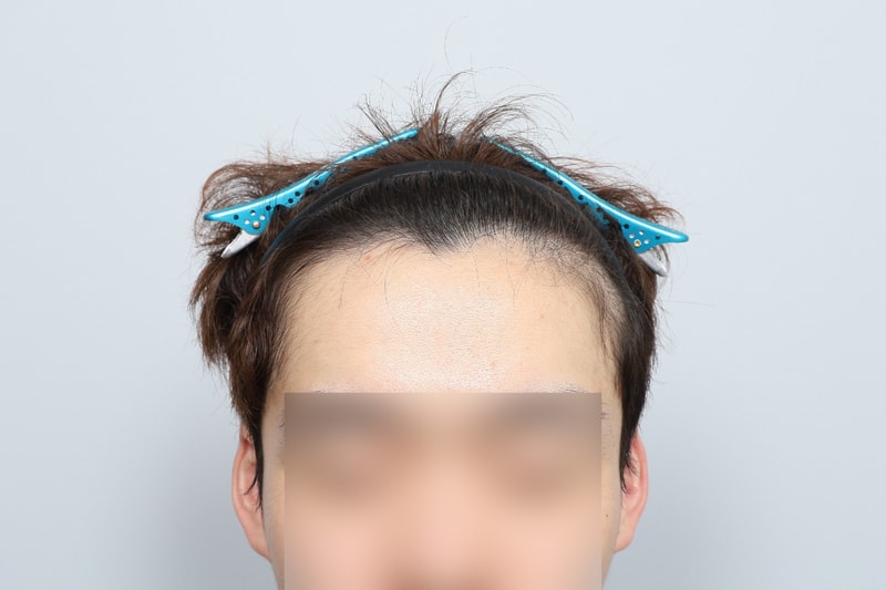 헤어라인 모발이식 5개월 경과 모원성형외과 정재홍원장님