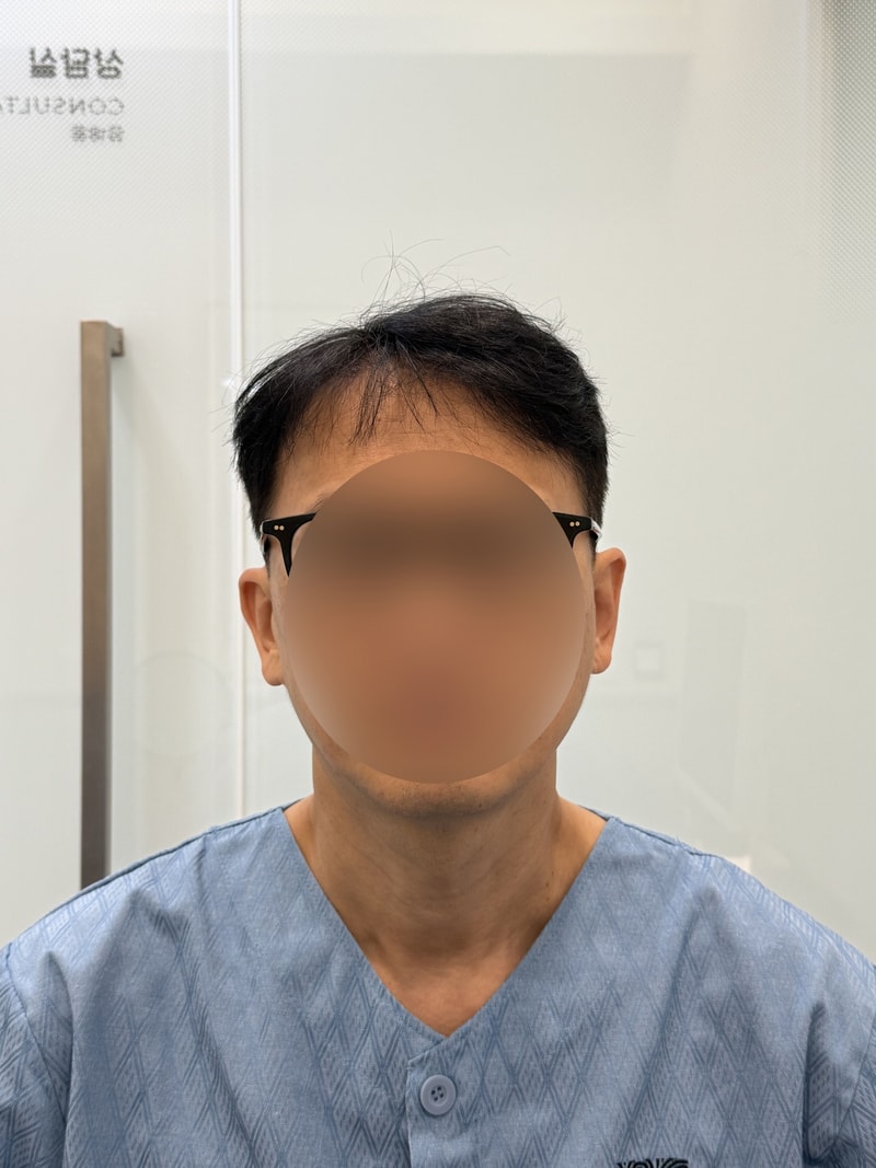 MO.1 plastic surgery 1800 hair follicle Hair Transplant 2 weeks after reoperation.