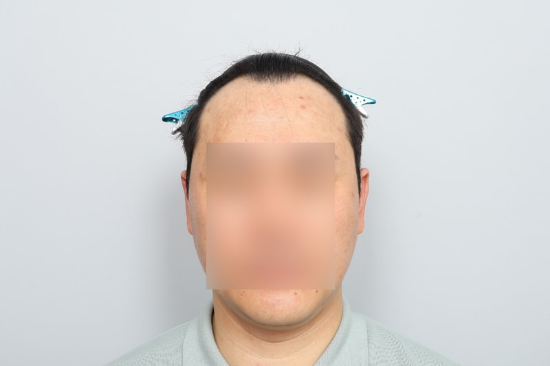 모원성형외과 M자이마 투블럭 비절개모발이식 7개월