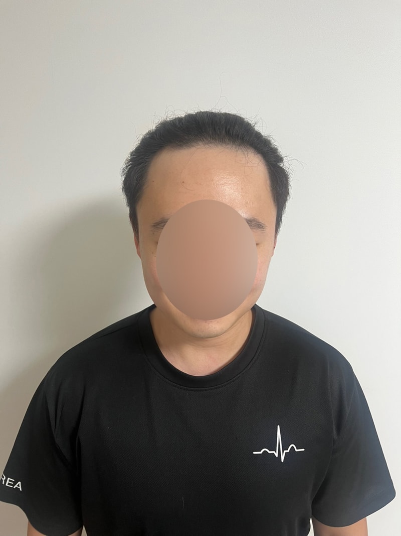 무삭발 비절개 헤어라인 모발이식 2300모낭 4개월 모원성형외과