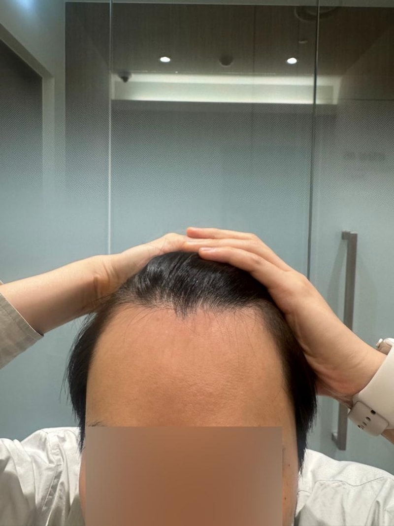 헤어라인 비절개모발이식 7개월 모원성형외과