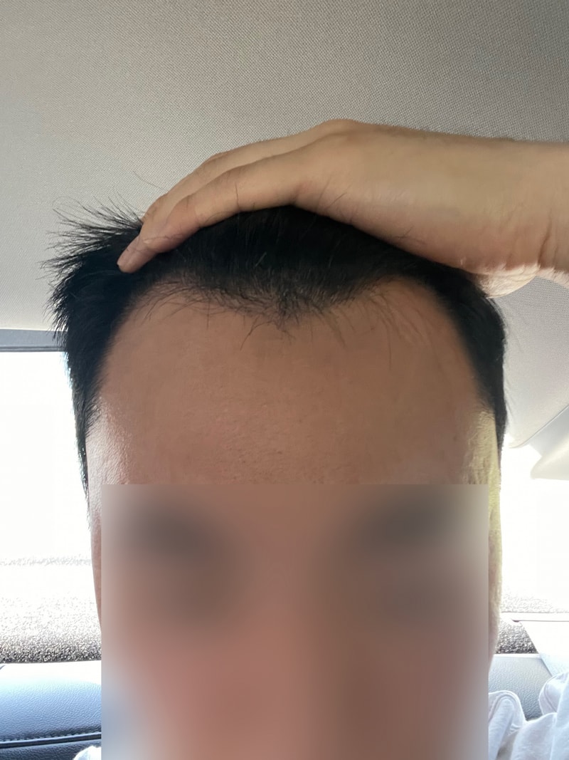 모원성형외과 M자이마 모발이식(부분삭발비절개) 12개월후기