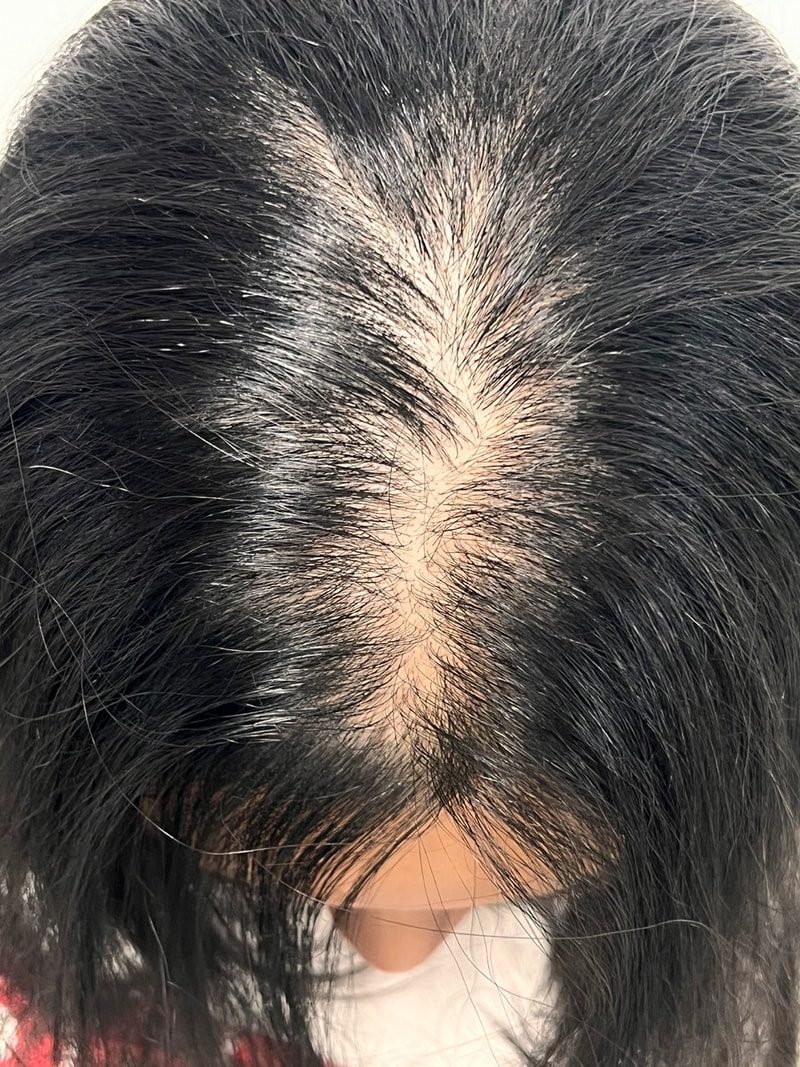 모원성형외과 정수리+헤어라인 1일차 후기 적어봅니다