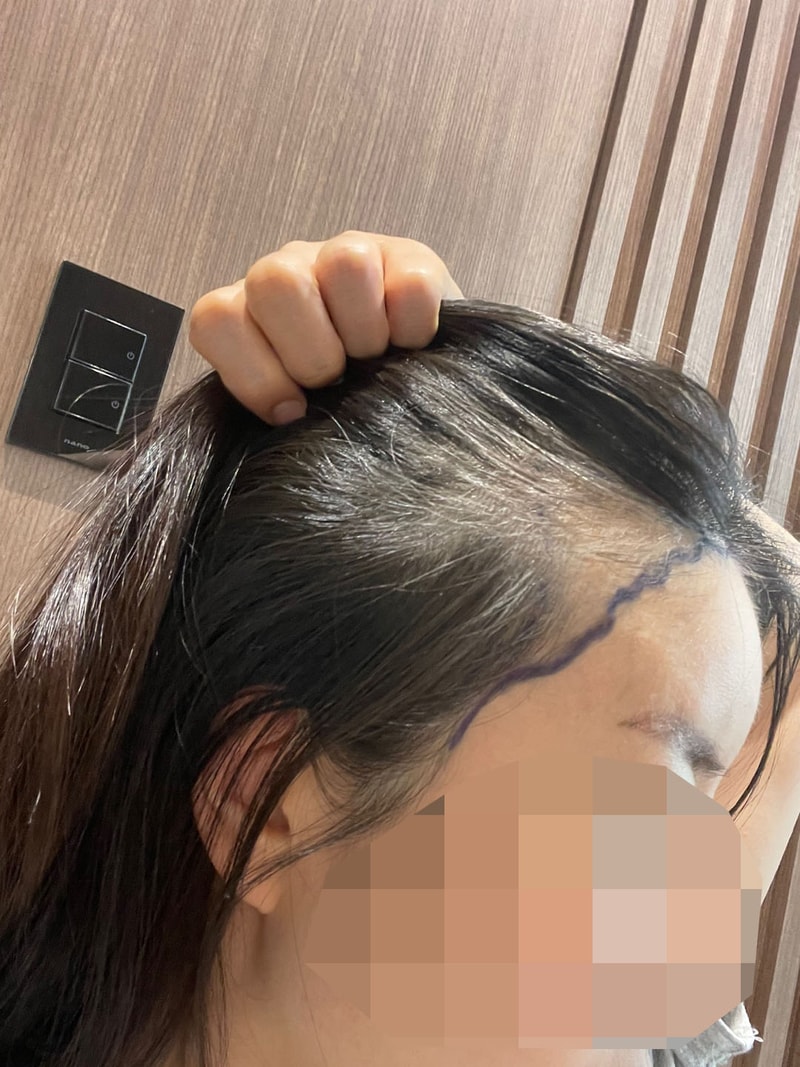 모원성형외과에서 헤어라인 1200모낭 비절개 부분삭발 후기 적어볼게요!