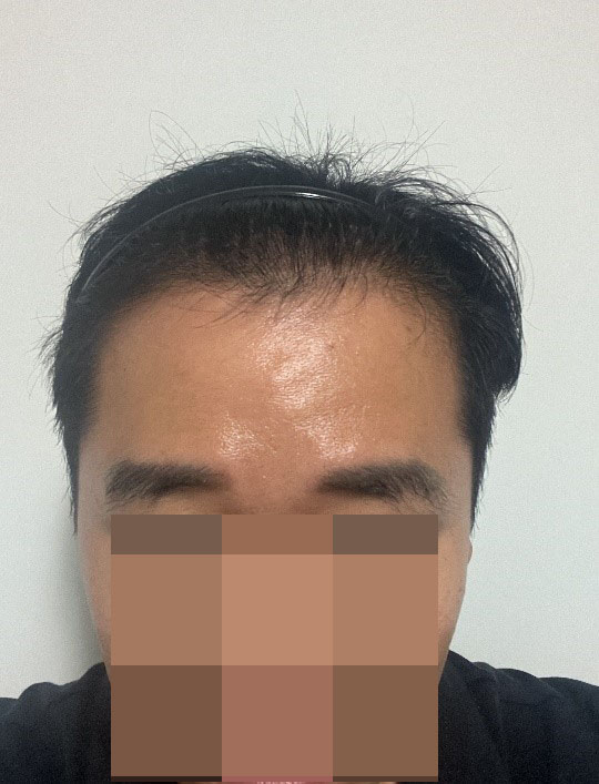 모원성형외과에서 모발이식 받은지 5일차 후기 남겨봐요 (정재홍 원장님)