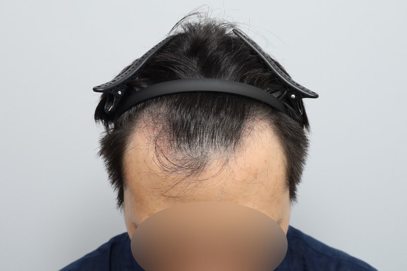 모원성형외과 무삭발비절개 모발이식 1850모낭 2주차 정재홍원장님