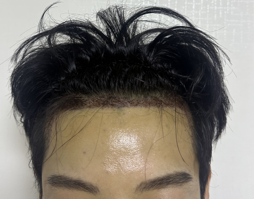 수술후_01.png