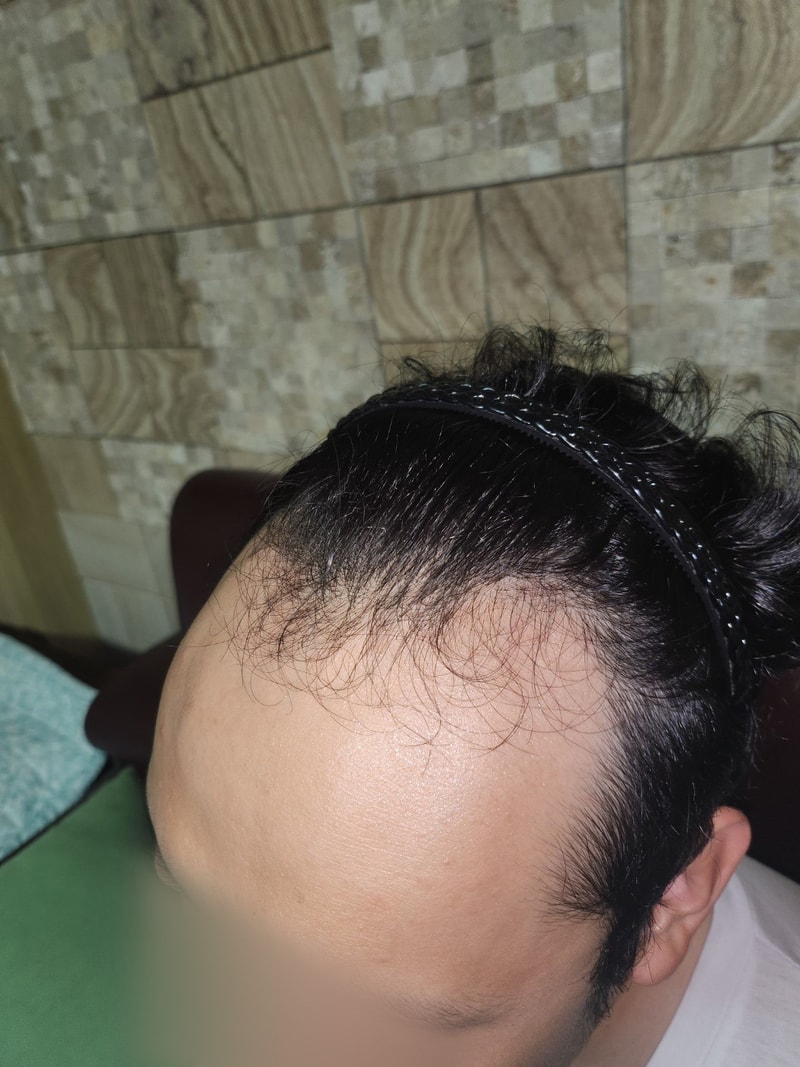 모원성형외과 무삭발 비절개 모발이식 3개월 정재홍원장님
