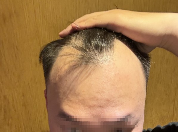 모원성형외과 정재홍원장님 비절개 투블럭 10일차 후기