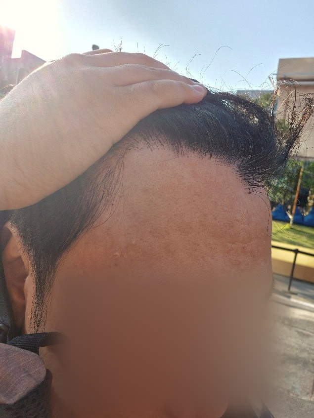After the M-shaped hair transplant review, I don't think I'm going to have another surgery