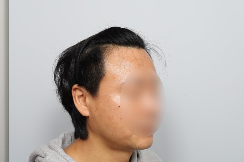 모원성형외과 M자 모발이식 1700모낭 12개월 정재홍 원장님
