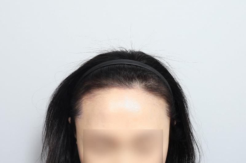 Women's Hairline 1,500 Hair Capsule No-Cutting Non-Cutting Hair Transplantation 4 Months Mowon Plastic Surgery Park Jong-ok, Director of Mowon Plastic Surgery