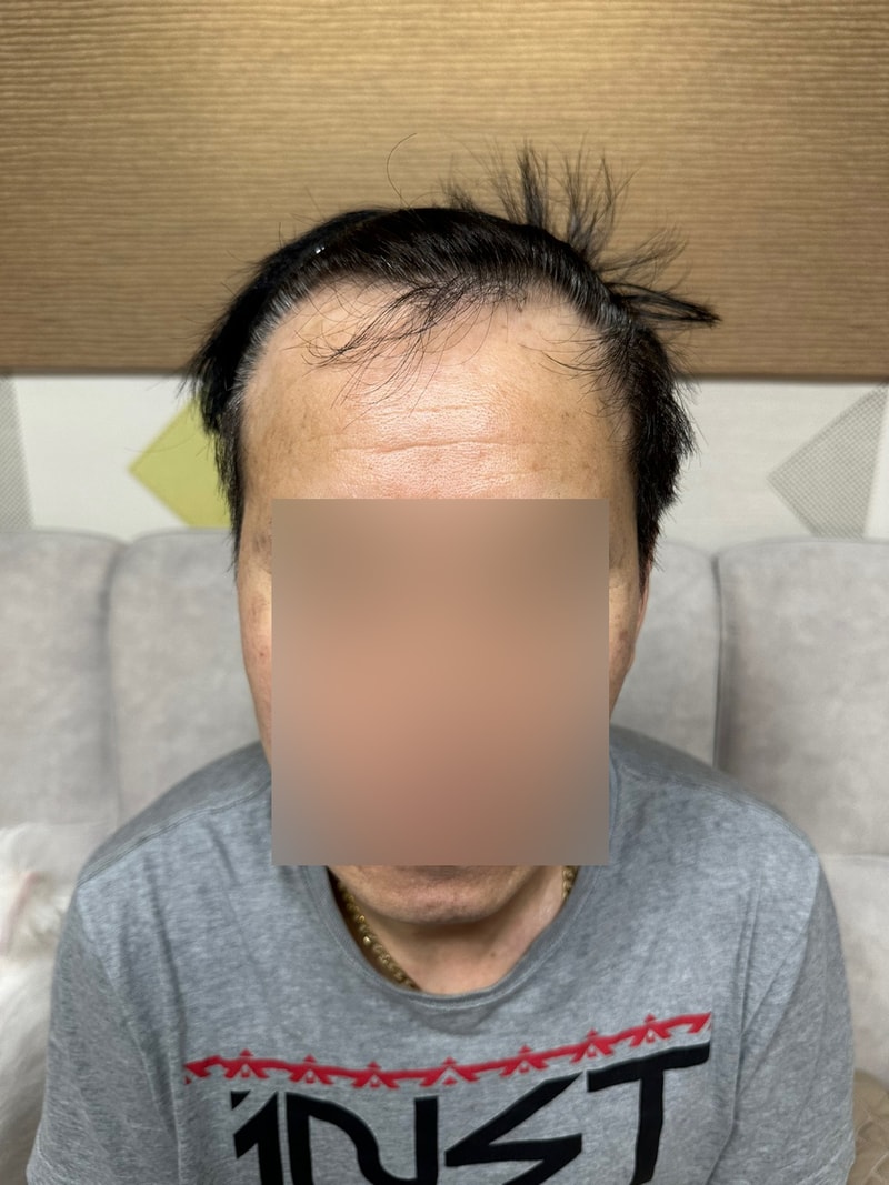 삭발비절개 헤어라인, 정수리 모발이식 7개월차 모원성형외과