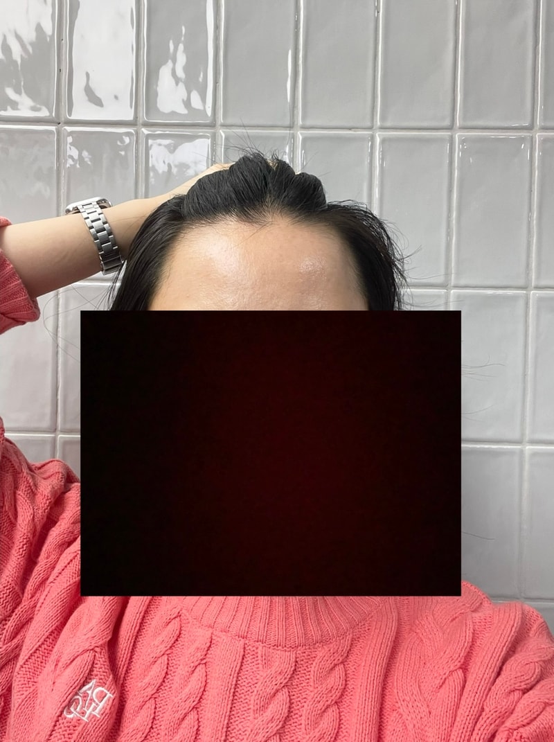 モウォン整形外科 無削髪 非切開 ヘアライン 植毛 1600株 11日目