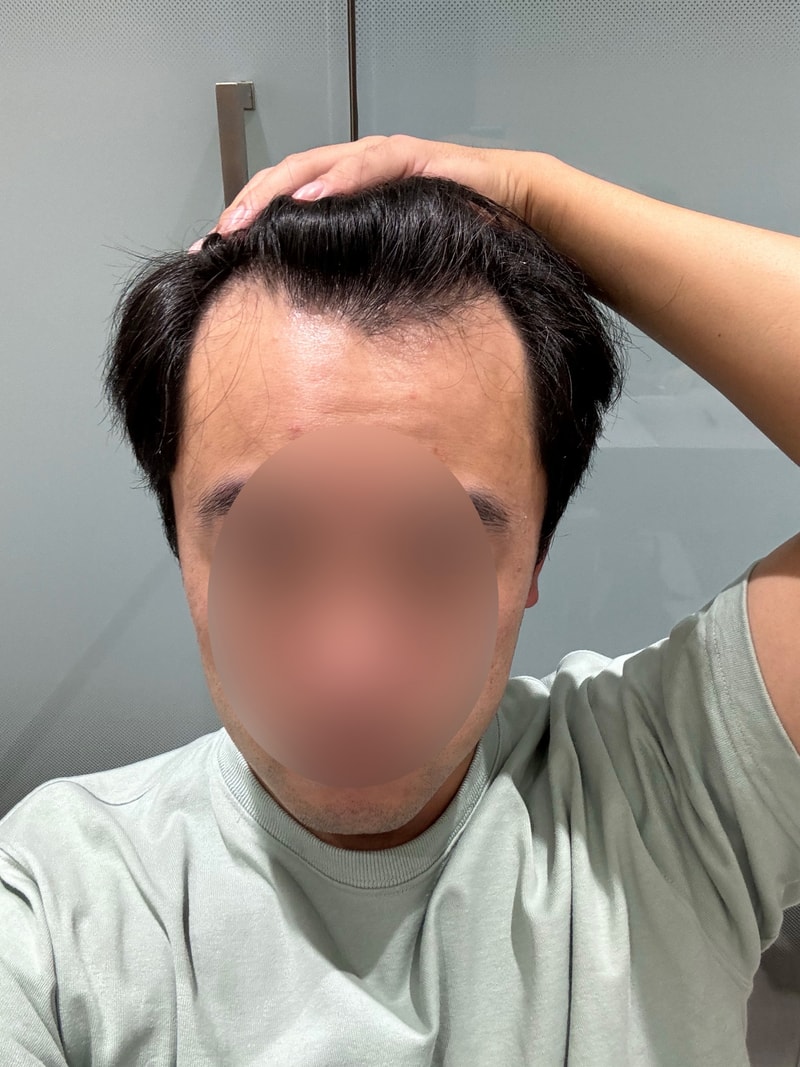 M자 이마 무삭발비절개 1600모낭 모원성형외과 정재홍원장님