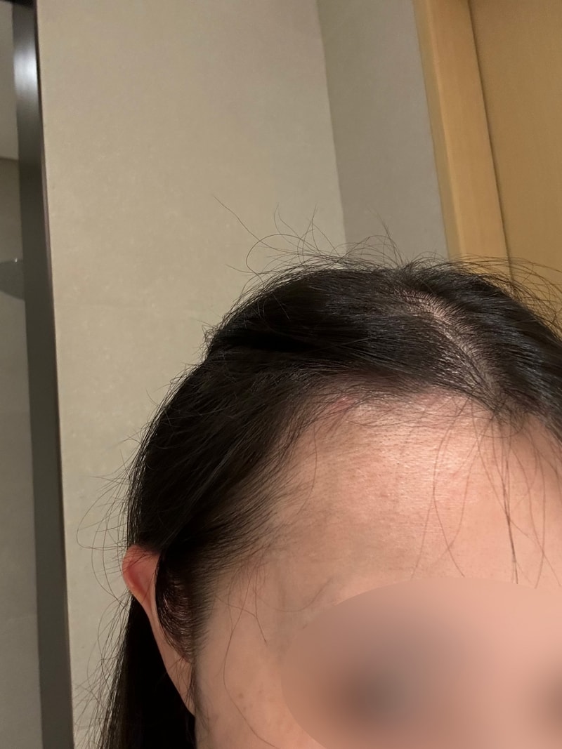 모원성형외과 <박종옥원장님> 여자헤어라인 비절개모발이식 1년!!