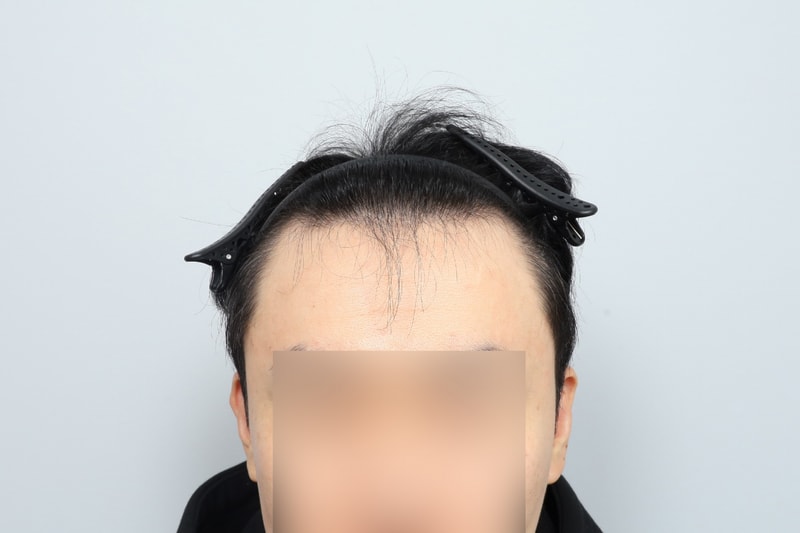 M-shaped forehead hairline 1200 hair follicle non-cut hair transplant + top scalp tattoo 4 months old hair plastic surgery