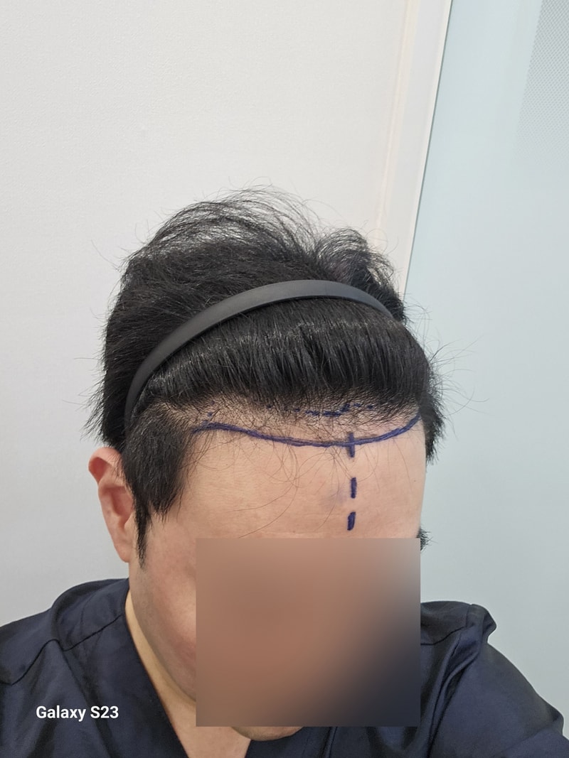무삭발 헤어라인+정수리 비절개모발이식 1280모낭 12개월 모원성형외과