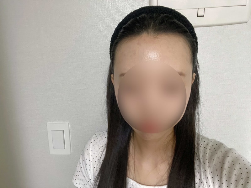 M자 이마 무삭발 비절개 헤어라인 1700모낭 모원성형외과 5일차