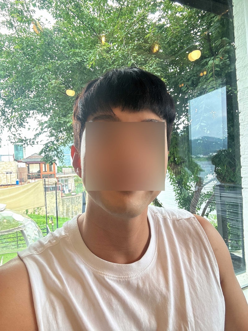 M자이마 무삭발 비절개 1400모낭 1년 후기입니다 모원성형외과