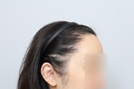 비절개모발이식 헤어라인재수술 밀도보강 1년 모원성형외과