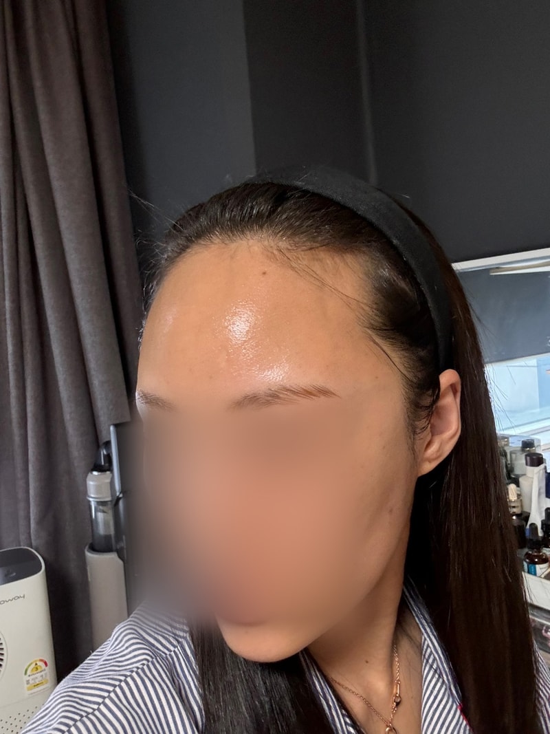 모원성형외과 헤어라인 4개월차 오랜만에 근황 전해요~