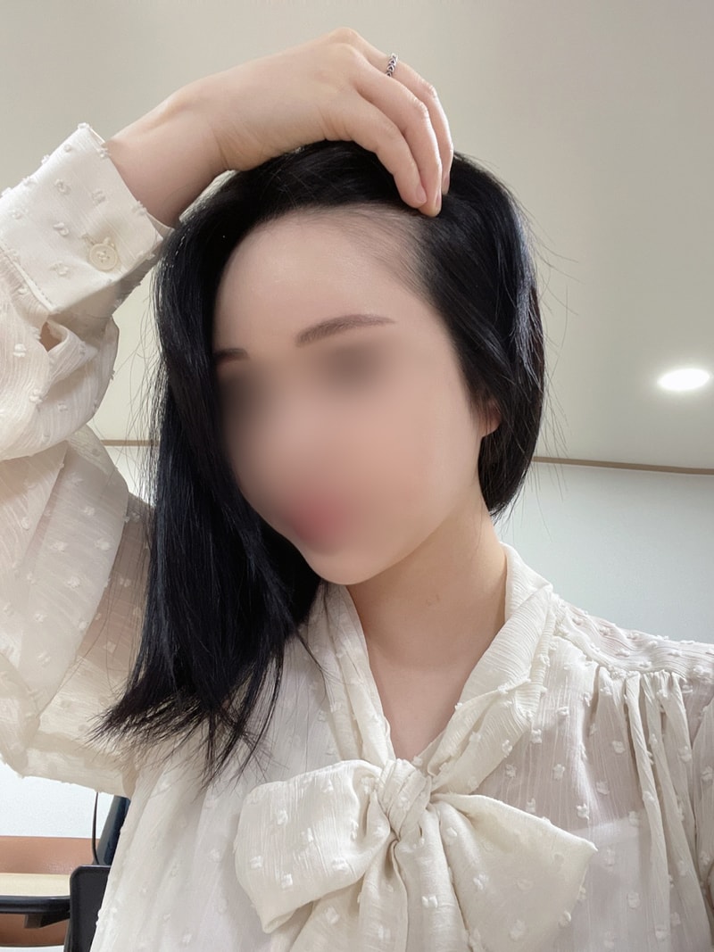 모원성형외과 여성헤어라인 비절개모발이식 12개월!