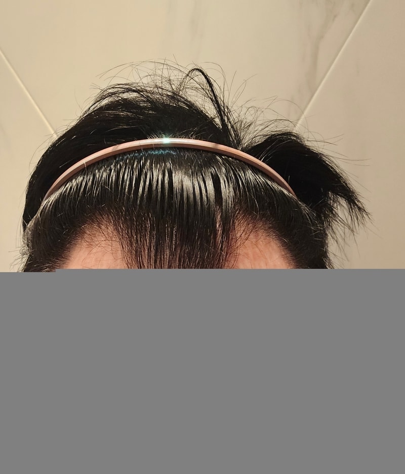 모원성형외과 M자이마 투블럭 비절개모발이식 4개월