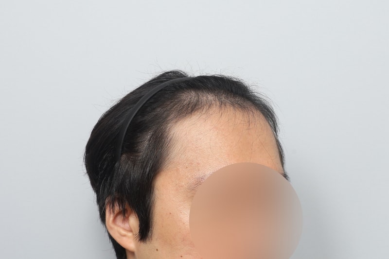 전두부 헤어라인 1900모낭 비절개 모발이식 1일차 모원성형외과