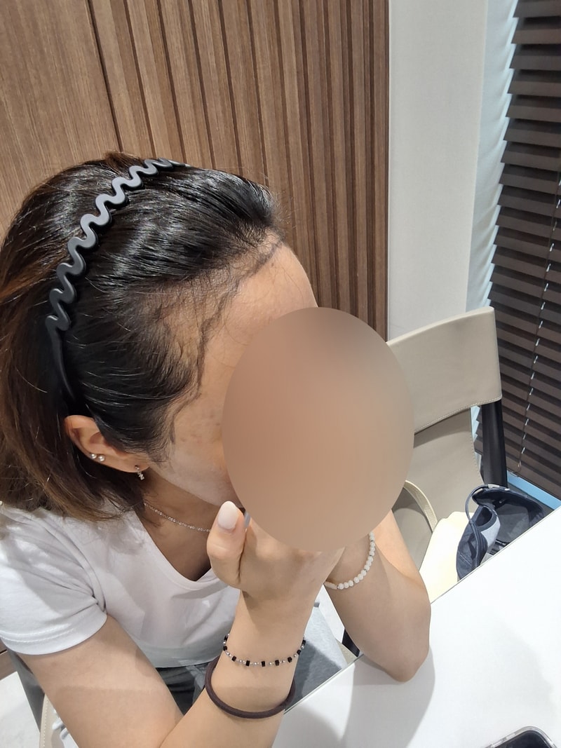 여자헤어라인 부분삭발 비절개모발이식 1년 모원성형외과