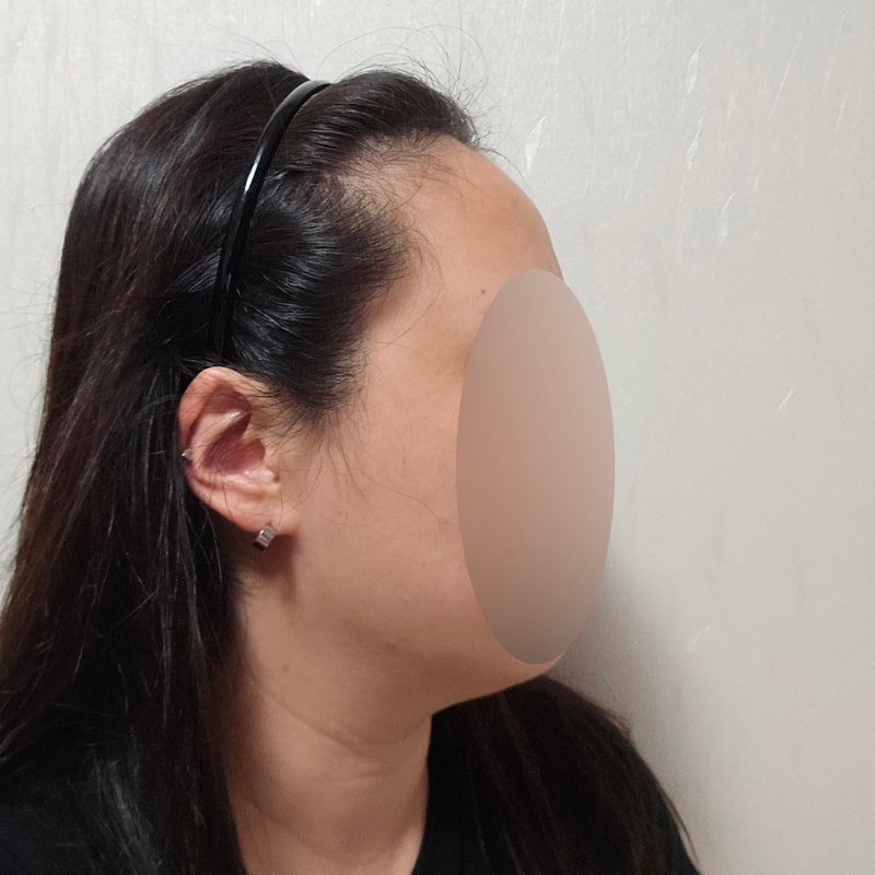 모원성형외과 (박종옥원장님) 여성헤어라인 모발이식 +12개월 후기