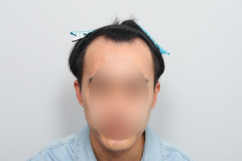 모원성형외과 M자이마 비절개 모발이식 2022모낭 7개월차