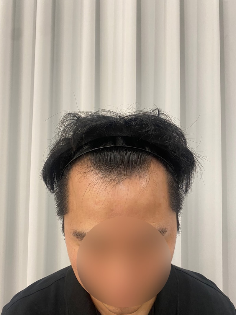 모원성형외과 M자이마 비절개모발이식 12개월차 (정재홍원장님)