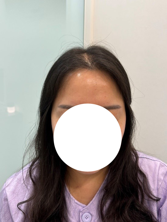 산후탈모 정수리 비절개 모발이식+두피문신 7개월차 모원성형외과