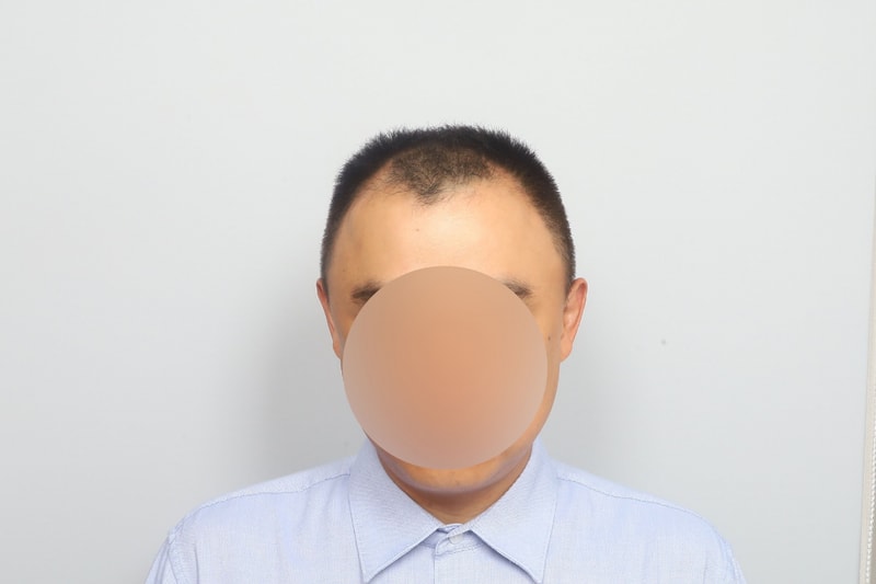 모원성형외과 M자이마, 구렛나루 비절개모발이식 1년 후기