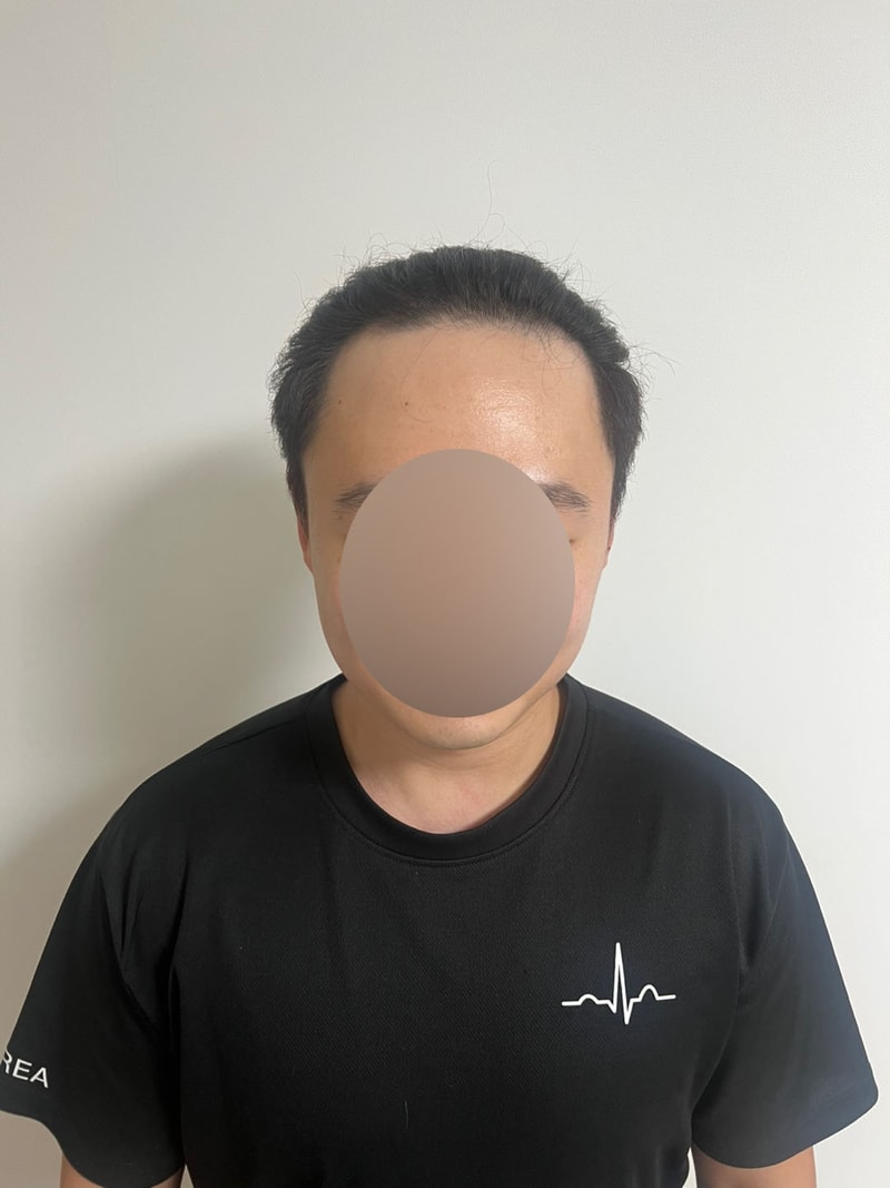 무삭발 비절개 헤어라인 모발이식 2300모낭 7개월 모원성형외과