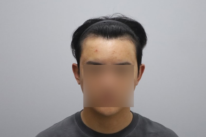 모원성형외과 비절개 M자 모발이식 3개월 경과(정재홍원장님)