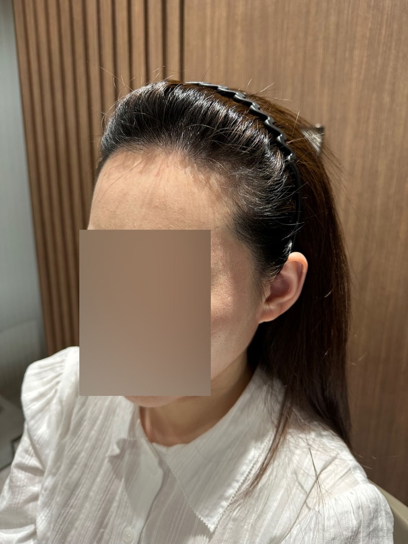 모원성형외과 여자헤어라인 롱헤어 모발이식 3개월차