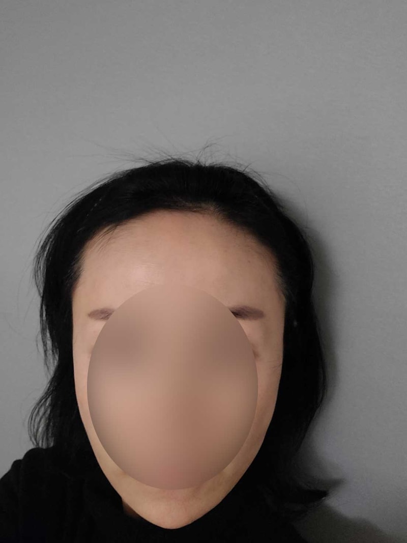Women's Hairline 1,500 Hair Capsule No-Cutting Non-Cutting Hair Transplantation 7 Months Mowon Plastic Surgery Park Jong-ok, Director of Mowon Plastic Surgery