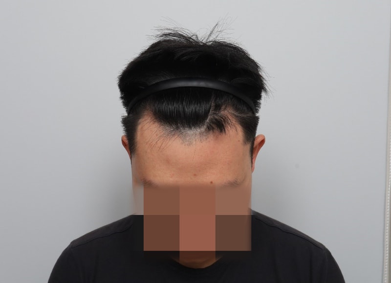 모원성형외과 부분삭발비절개 M자이식 3개월차 경과후기