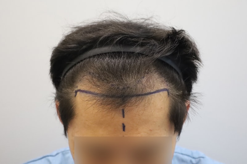 모원성형외과 비절개 모발이식 12개월
